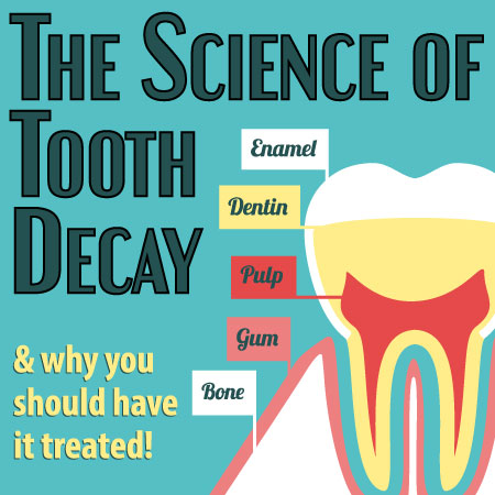 Tooth_Decay (1)