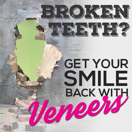 Veneers