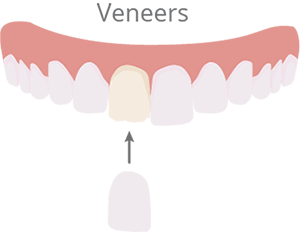Veneers Illustration