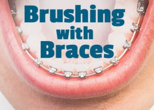 Granbury dentist, Dr. Jeff Buske of Granbury Dental Center informs patients about the best tools and tricks to use when performing oral hygiene routines with braces.