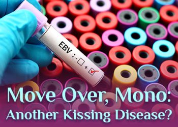 Granbury dentist, Dr. Buske at Granbury Dental Center, talks about a kissing disease you might be less familiar with than mononucleosis.