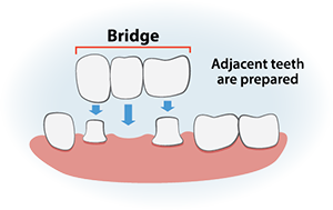 Dental Bridge Illustration