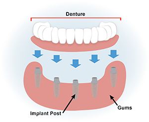 Dental Implant Illustration