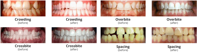 Invisalign Before and After