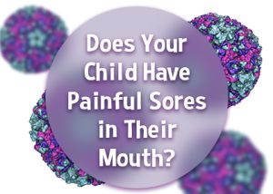 Granbury dentist, Dr. Jeff Buske at Granbury Dental Center tells parents about a common viral infection that may present with sores in your child’s mouth. 