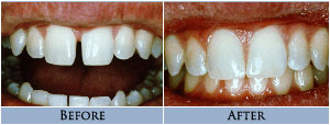 Cosmetic Bonding Before and After